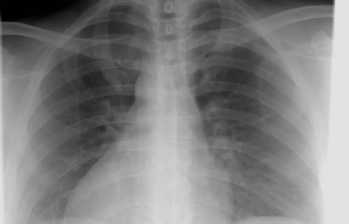 Radiografía de tórax; Sacyl analizará ahora los resultados con inteligencia artificial.