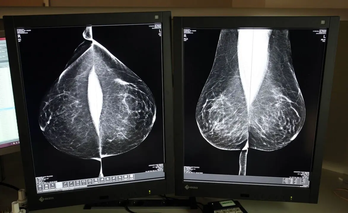 Estudio una mamografía digital, en el servicio de mamografías del Hospital Río Hortega de Valladolid. Foto: Rubén Cacho.