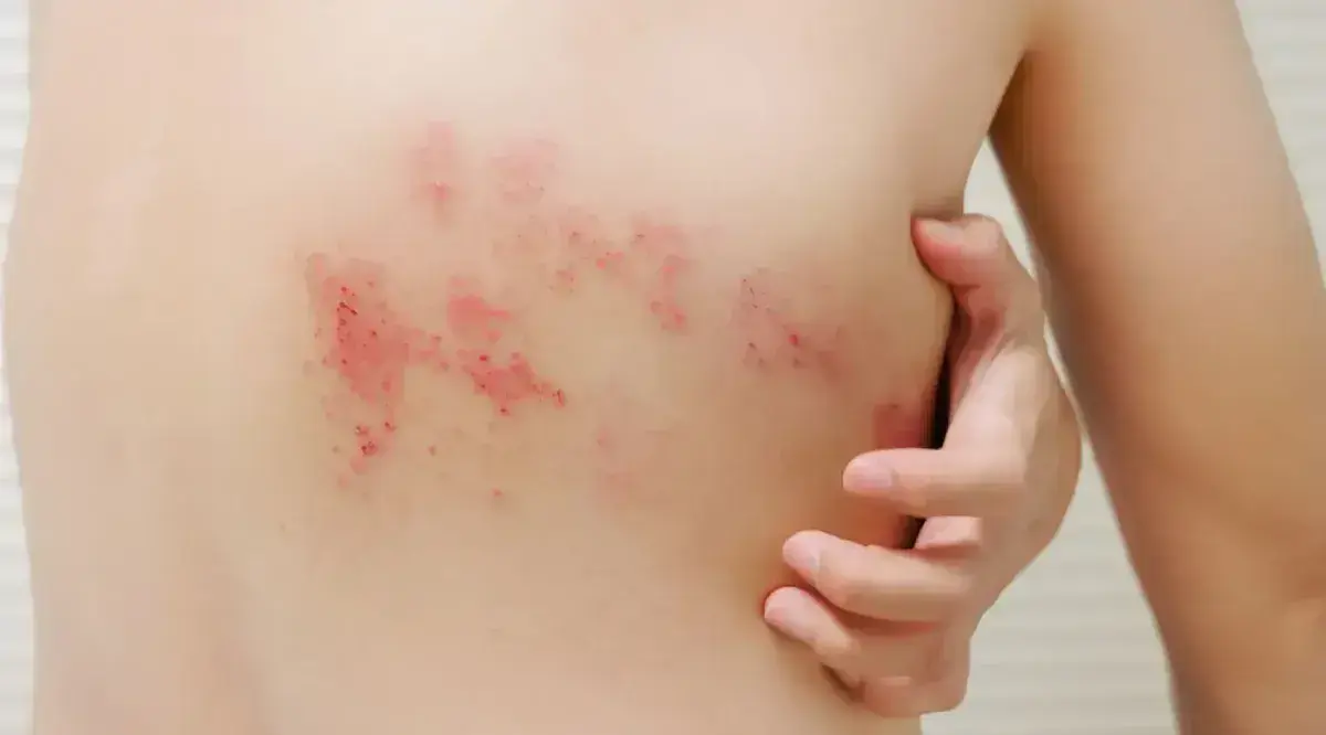 El virus herpes zóster es el causante de la varicela, que es cómo se manifiesta la enfermedad la primera vez que la persona se infecta.