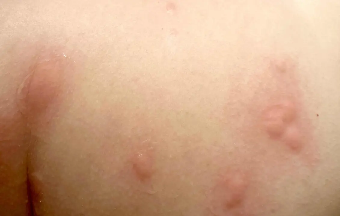 Imagen de algunas de las picaduras sufridas por una de las usuarias de la piscina de S&aacute;enz de Miera, hasta cincuenta ha contabilizado en su cuerpo.
