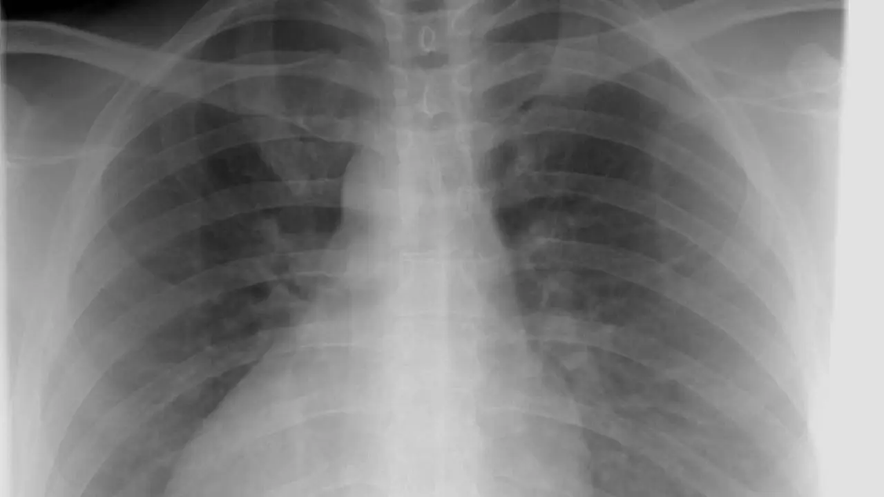 Radiografía de tórax; Sacyl analizará ahora los resultados con inteligencia artificial.