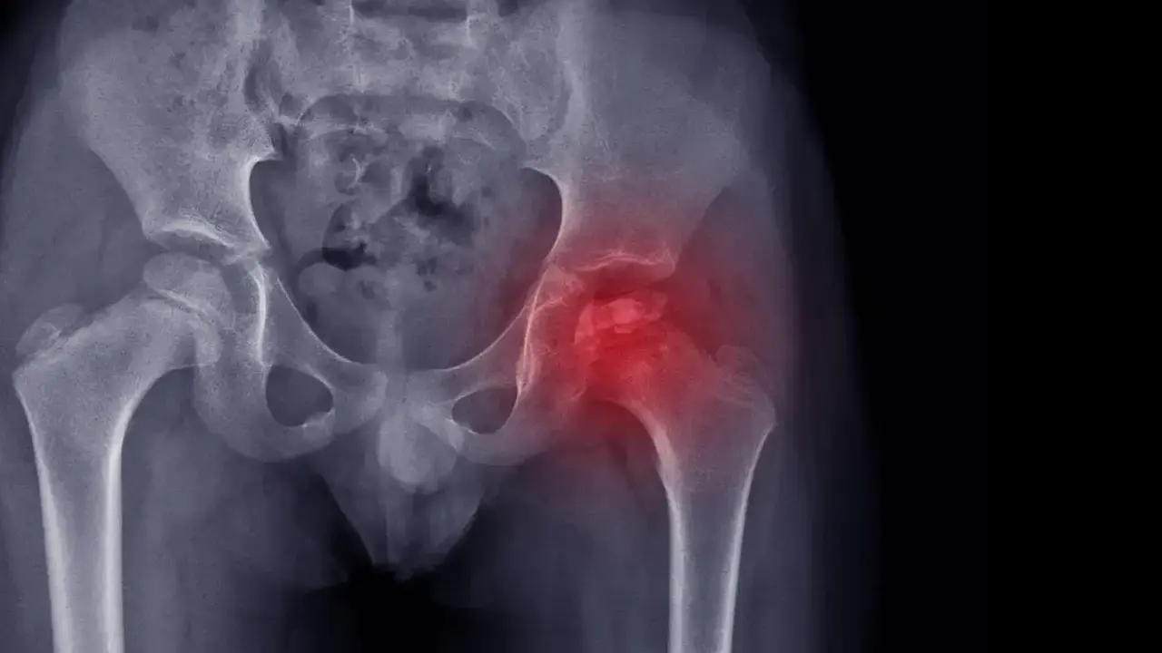 perthes-enfermedad