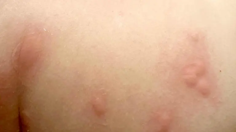 Imagen de algunas de las picaduras sufridas por una de las usuarias de la piscina de S&aacute;enz de Miera, hasta cincuenta ha contabilizado en su cuerpo.