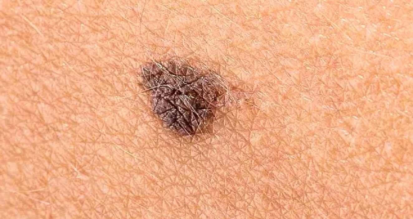 Imagen del tipo de melanoma, uno de los más agresivos.
